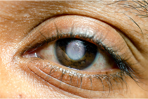 Retina & Glaucoma Treatment