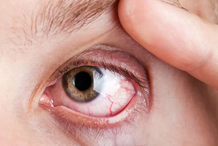 Diabetes Eye Care